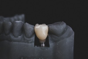 Dental implat near you