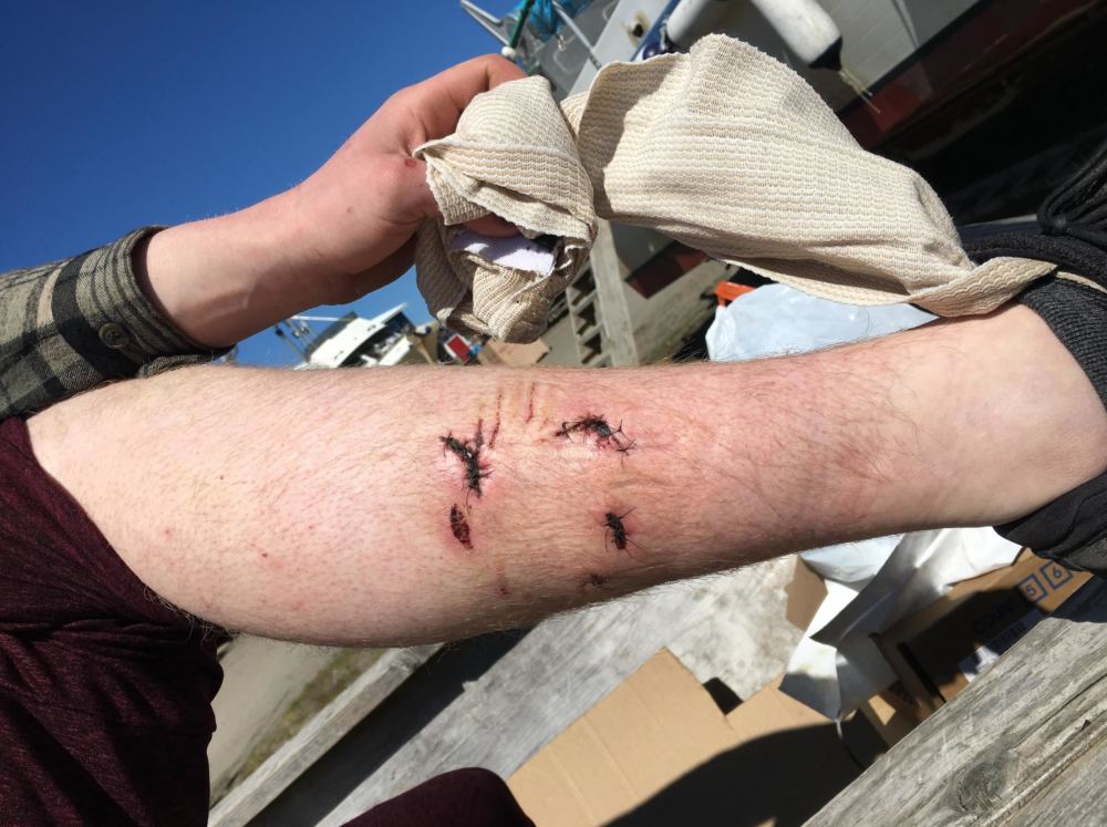 Stig Ure's leg had to receive 14 stitches after being bit by the bear. (Photo by Mitch Borden/KMXT) CREDIT MITCH BORDEN