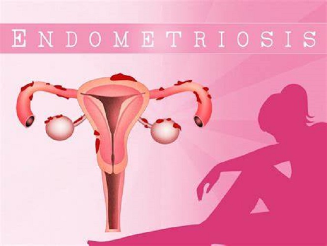Uterine Cancer
