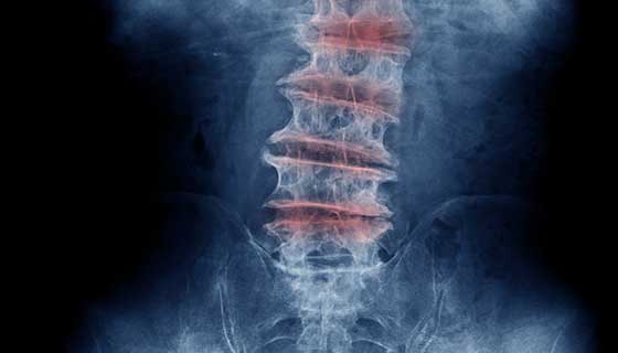 Spinal Muscular Atrophy