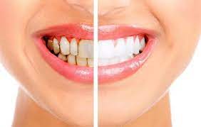 Whitening