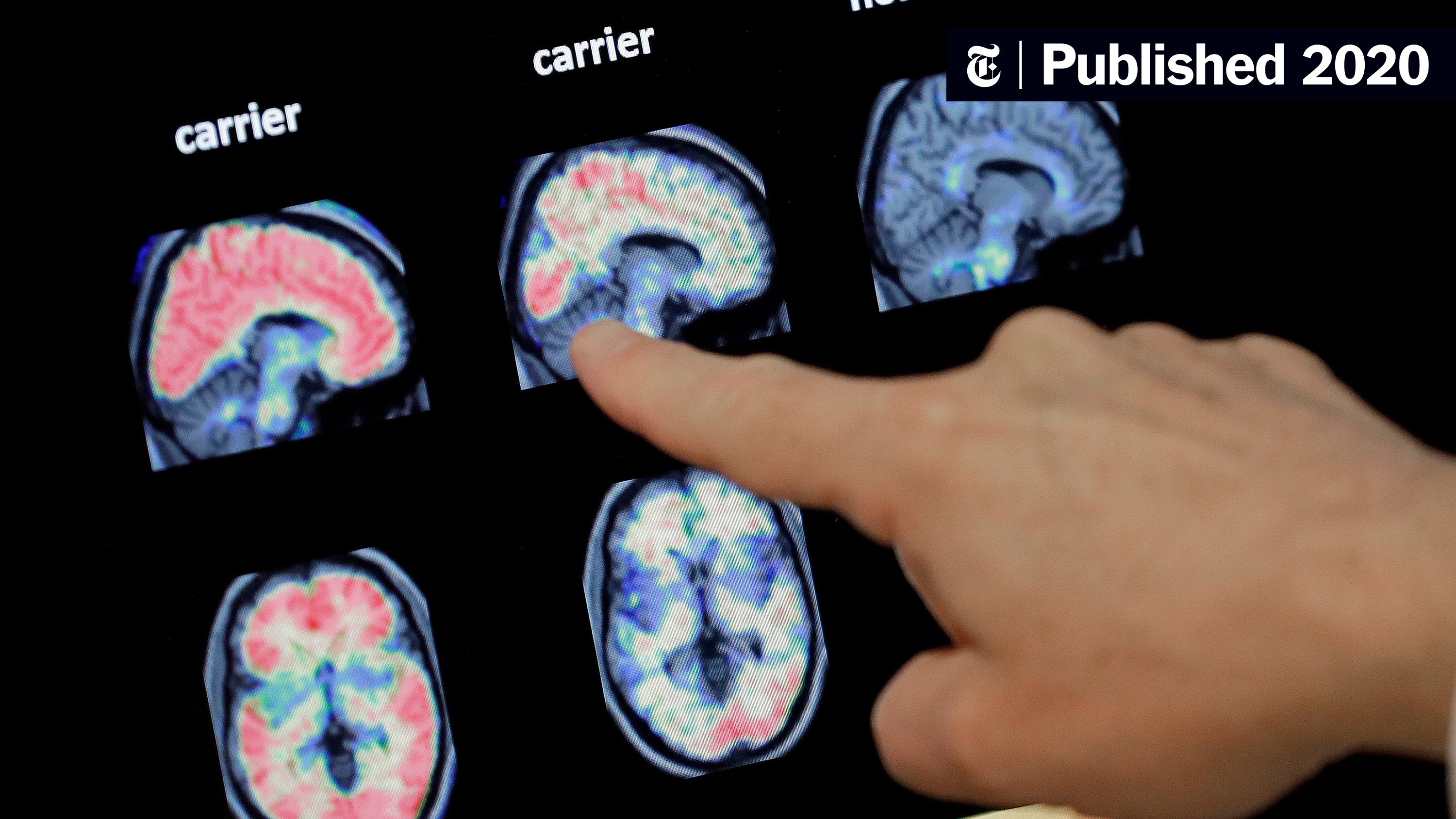 Signs of Early Onset Alzheimer's