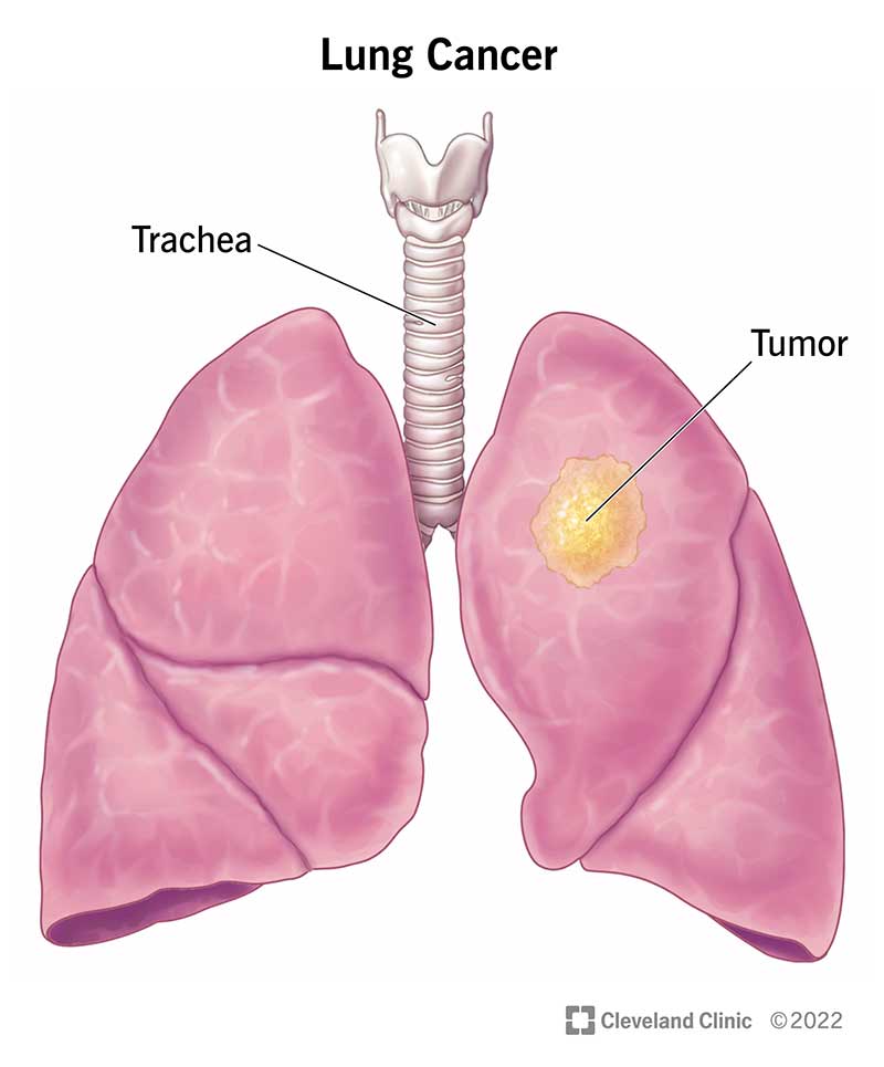 Early Detection, Prevention, and Treatment of Lung Cancer: What You Need To Know