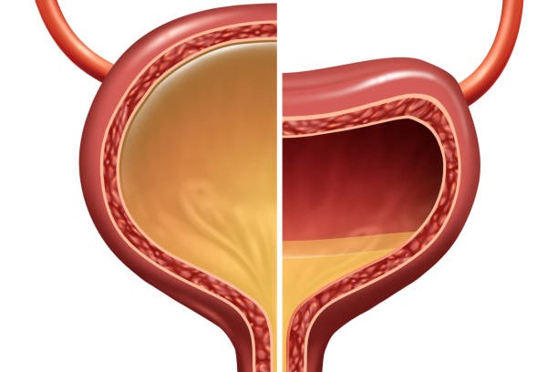 Urinary Tract Infection