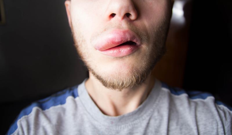 What Is Hereditary Angioedema and Its Causes