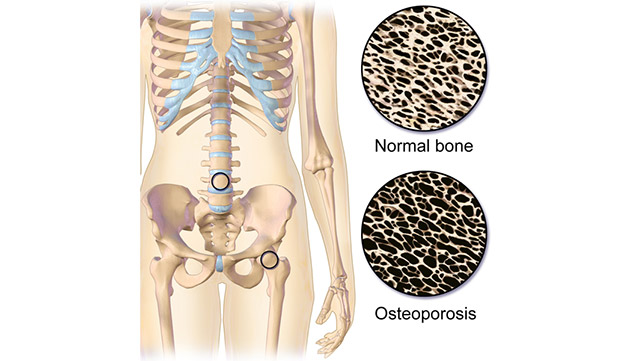 Facts About Osteoporosis