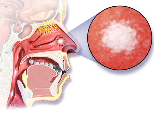 Hereditary Angioedema