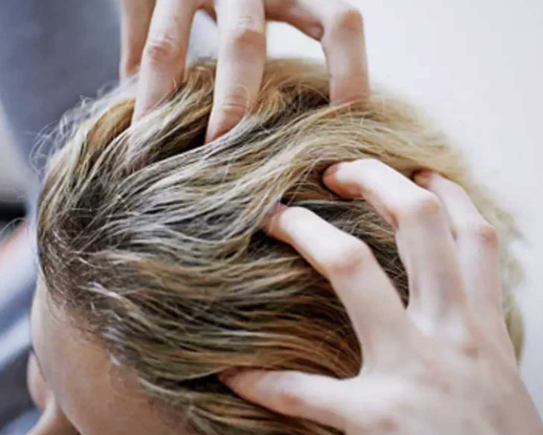 Remedies For Scalp Psoriasis