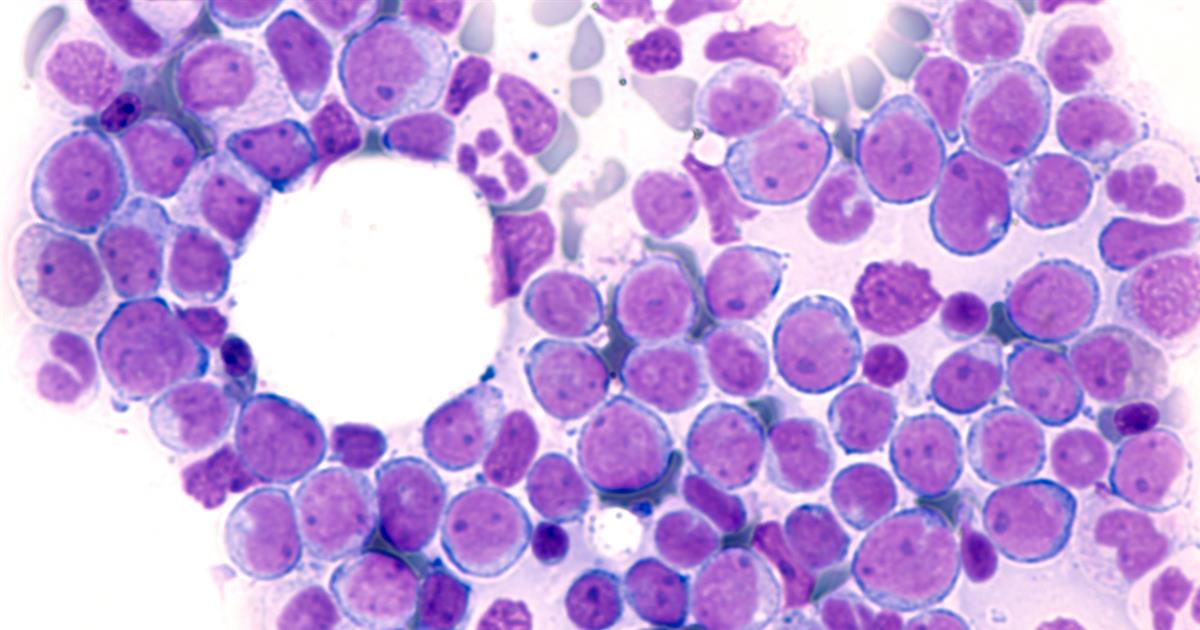 Thrombocytopenia