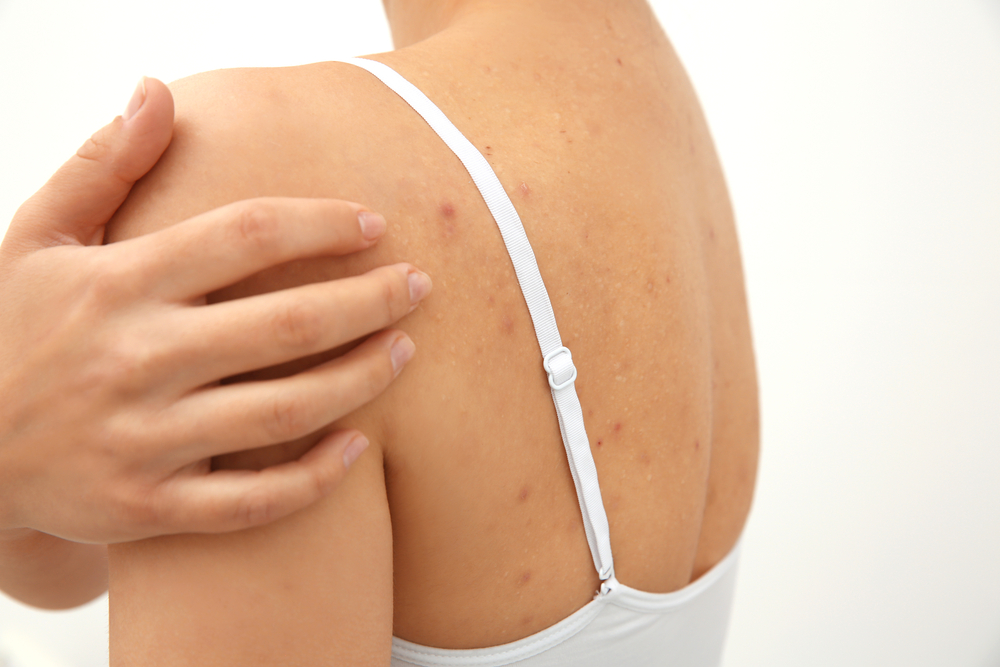 Everything You Need to Know About Hidradenitis Suppurativa