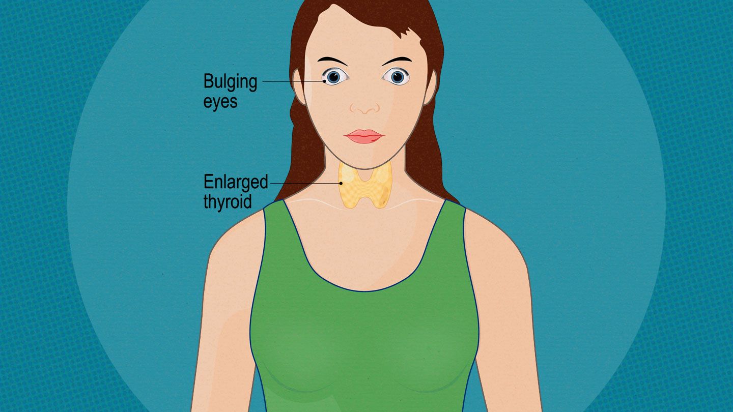 Thyroid Eye Disease