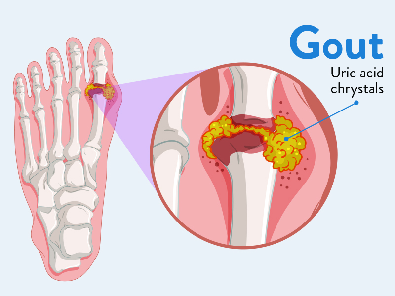 Best Treatment For Gout