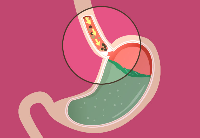 Gastric Bypass