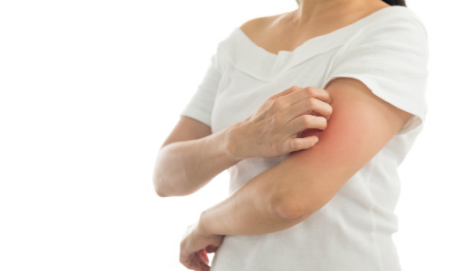 Treatment Options for Plaque Psoriasis Relief