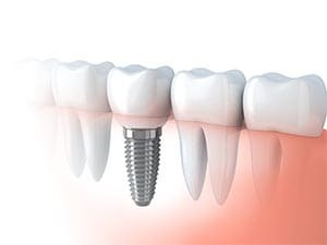 All On 4 Dental Implants Near Me