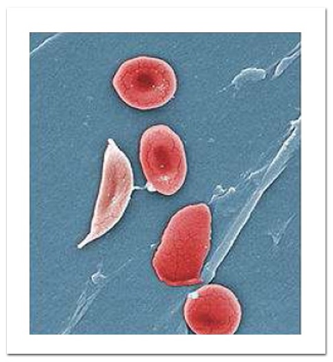 位的3:Forskellen pa en拉斯克rød blodceller噩den muterede seglcelle. De to celler er her bliver undersøgt i et elektronmikroskop og efterfølgende farvet.