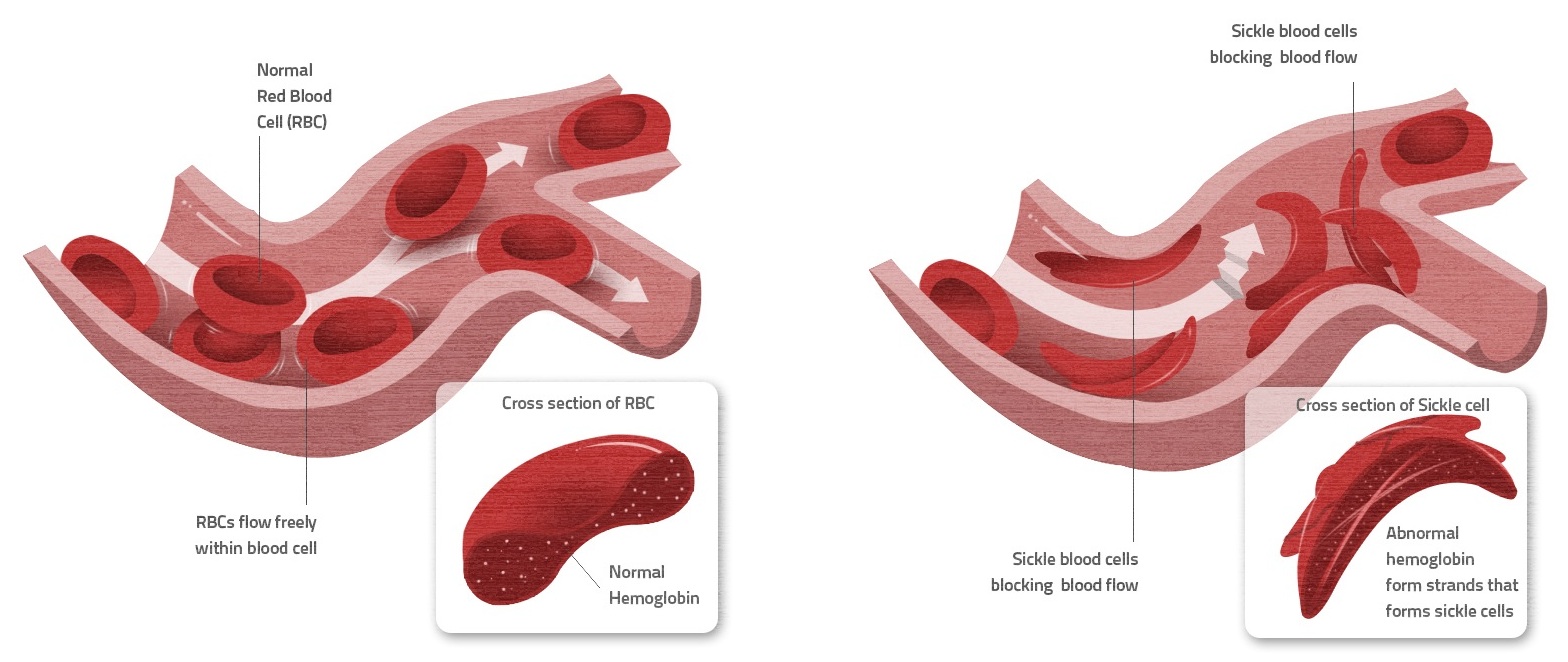 Figur 5: En af ulemperne ved seglceller, er den øgede risiko for blodpropper. I modsætning til de normale røde blodceller, som er smidige og derfor nemt kan komme igennem snævre blodkar, er seglceller mere faste i det. Derfor har de nemmere ved at lave en blokade i blodbanen og dermed stopper tilførslen af blod.