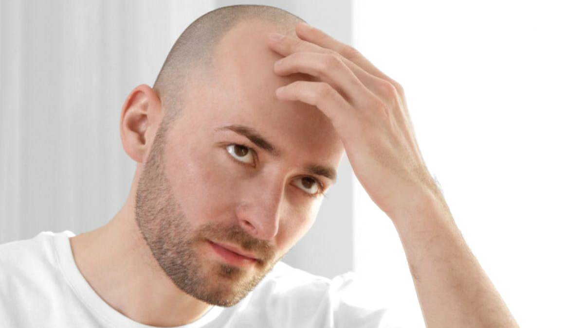 alopecia.jpg