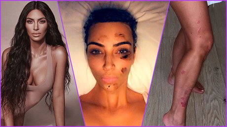 kim kardashian enfermedad que le aqueja desde adolescente (1).jpg