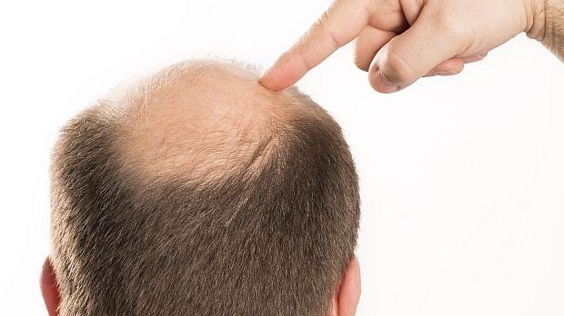 pérdida de cabello.jpg