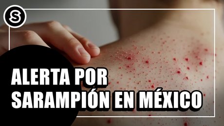 sarampion-hor