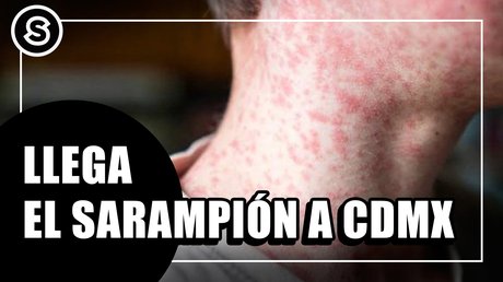 sarampion