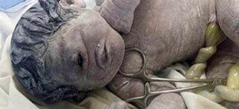埃及单眼畸形婴儿诞生,生命只有几天