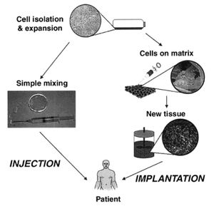 Fig. 8: Schematic illustration of typical tissue engineering approaches. Cells are obtained from a small biopsy from a patient, expanded in vitro, and transplanted into the patient either by injection using a needle or other minimally invasive delivery approach, or by implantation at the site following an incision (cut) by the surgeon to allow placement[14].