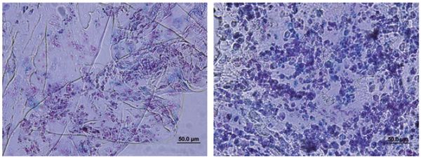 Fig. 3: Alcian blue staining of cartilage construct comprising a PEG hydrogel seeded with MSCs, after 4 weeks of culture (GAG stained blue, nuclei stained red). (left) Blank hydrogel containing TGF-b3; (right) hydrogel containing triple-helical (GPO)4GFOGER(GPO)4GCG sequence and TGF-b3. Construct containing GPO)4GFOGER(GPO)4GCG produced an abundance of cartilage-specific ECM rich in GAG[13].