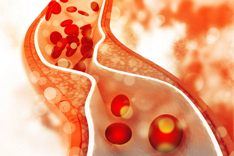 Cholesterol-plaque-in-artery.jpg