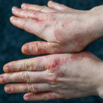 FB-Histamine-Intolerance-150x150.jpg