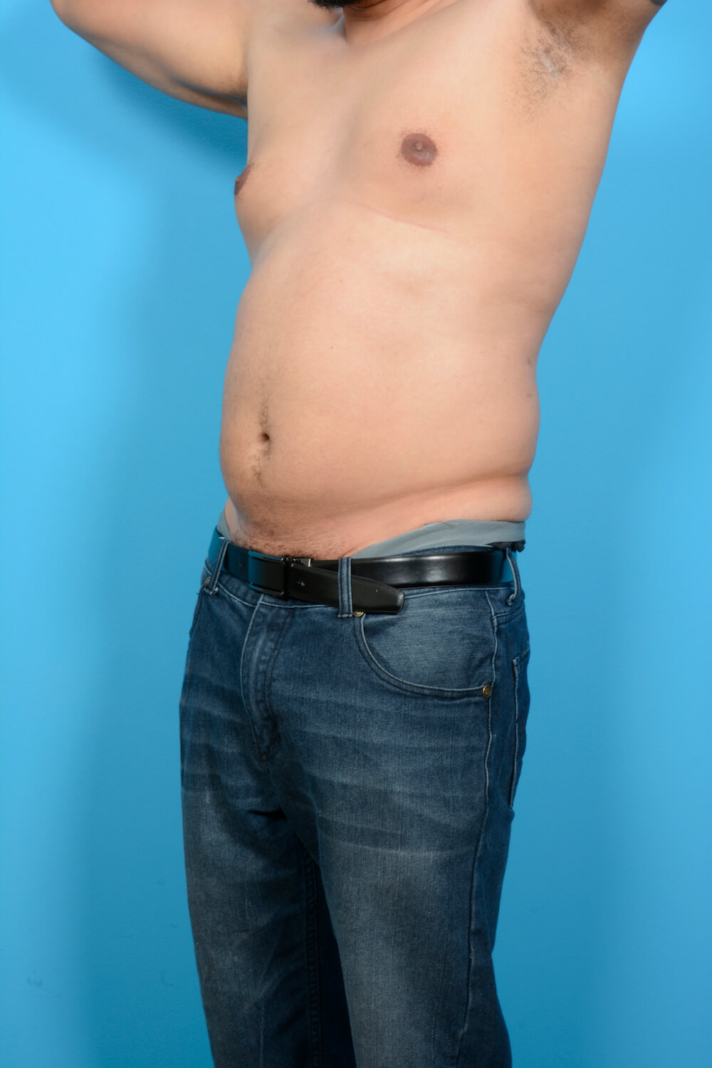 Abdominal Etching Plus Vaser Sculpt Aesthetic Center