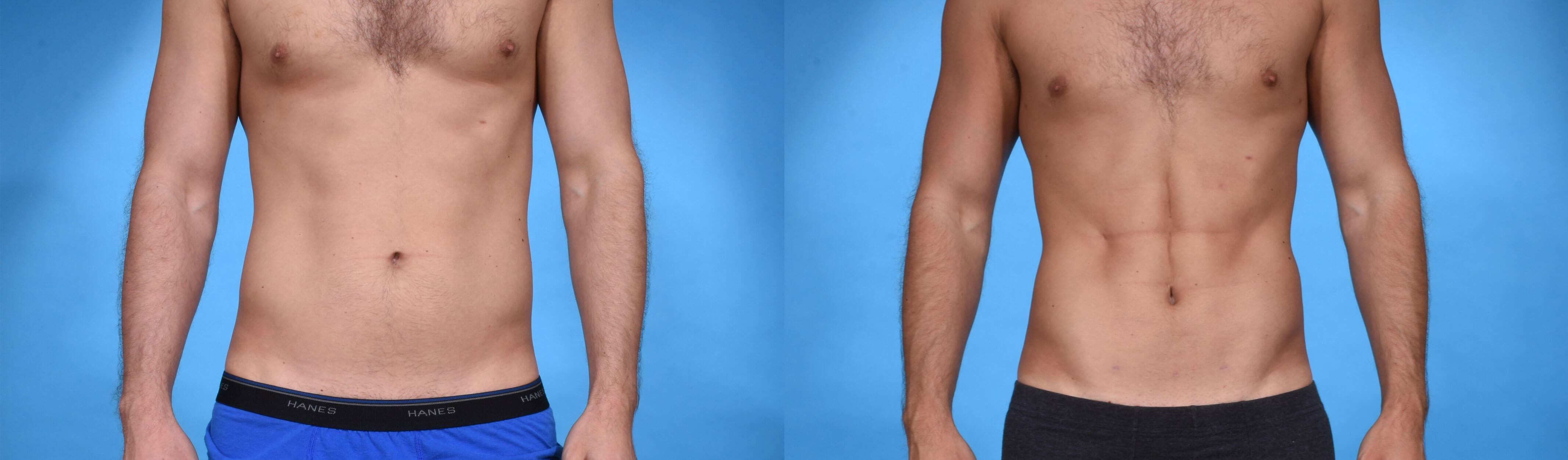 Abdominal Etching Dr. Daniel O. Beck