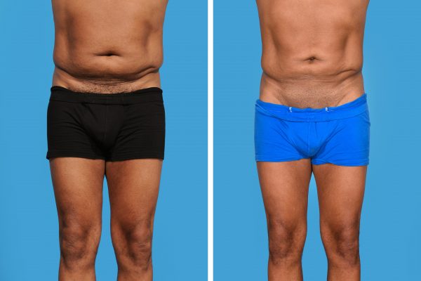 Tummy Tuck | Dr. Daniel O. Beck
