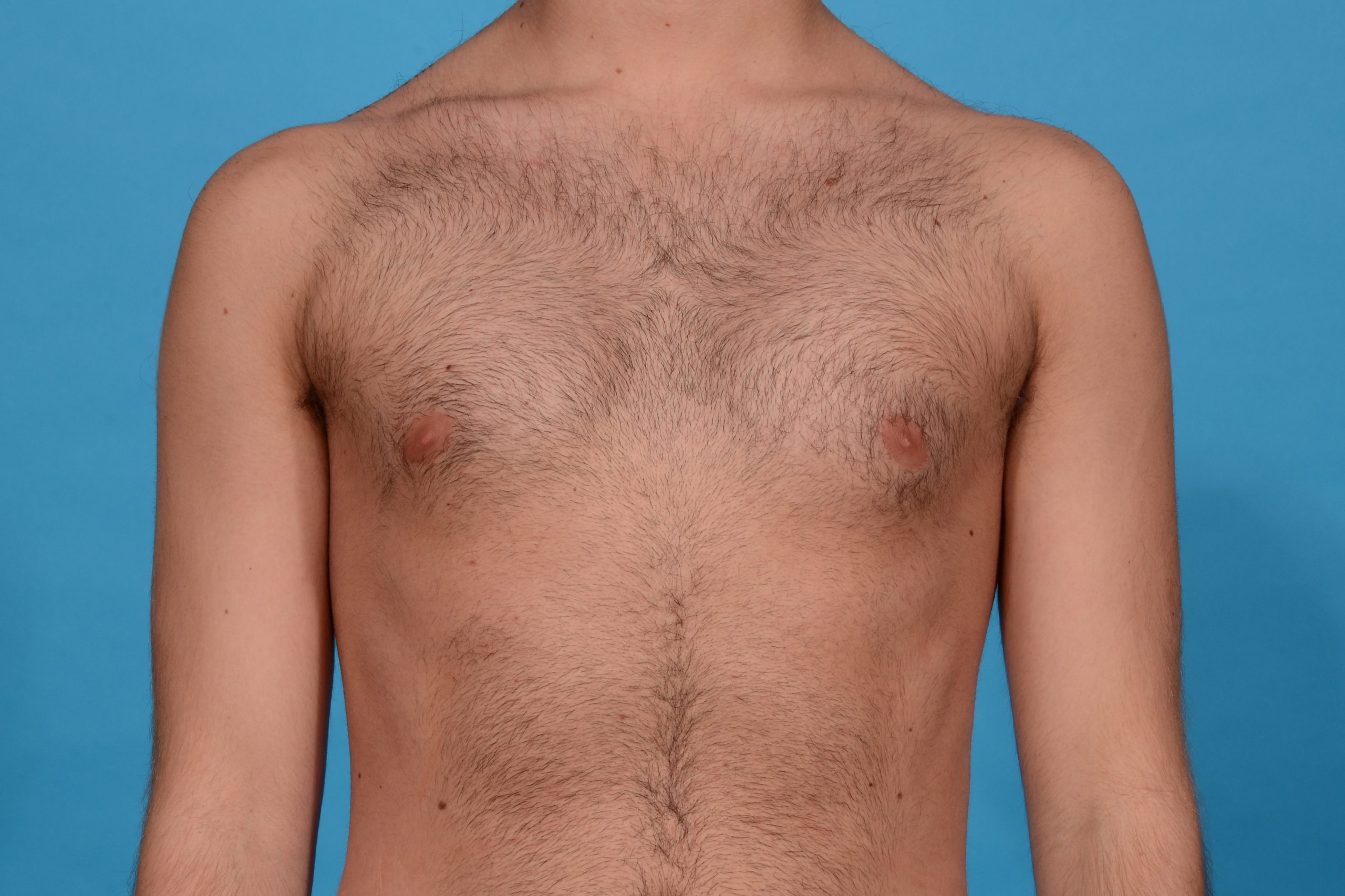 Operacion Aumento De Pecho Natural Chest Contouring with Pectoral Augmentation in Dallas, Texas | Dr
