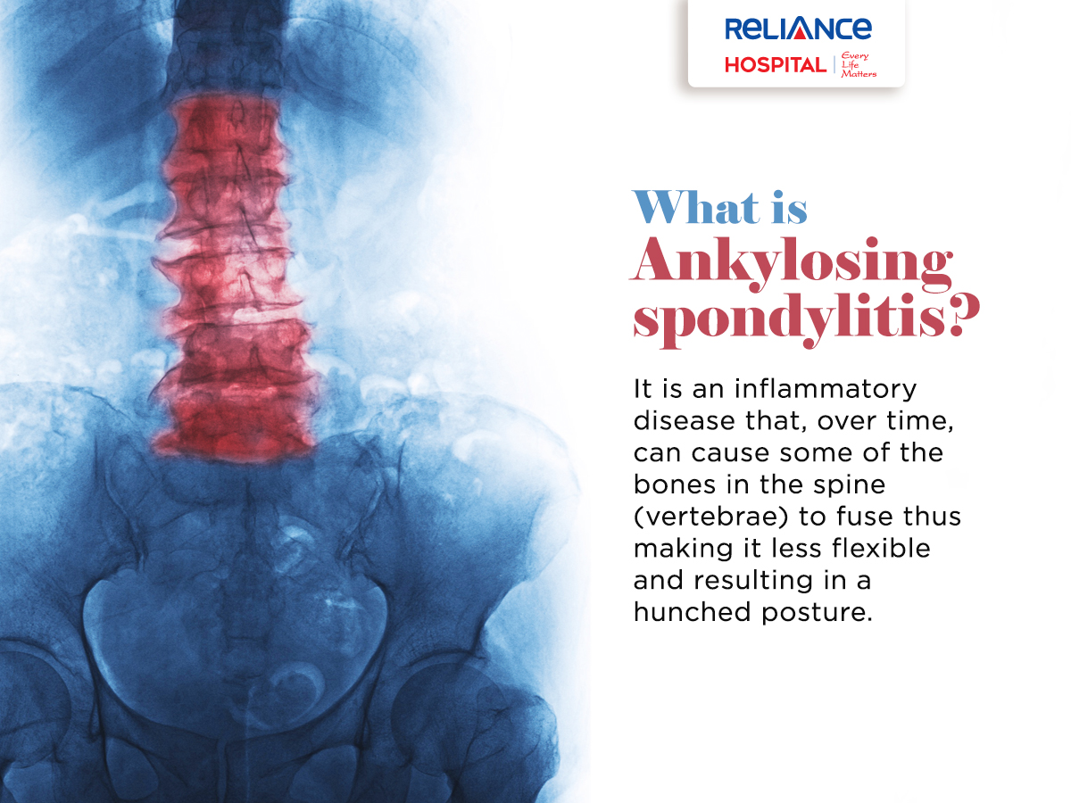 What is ankylosing spondylitis?
