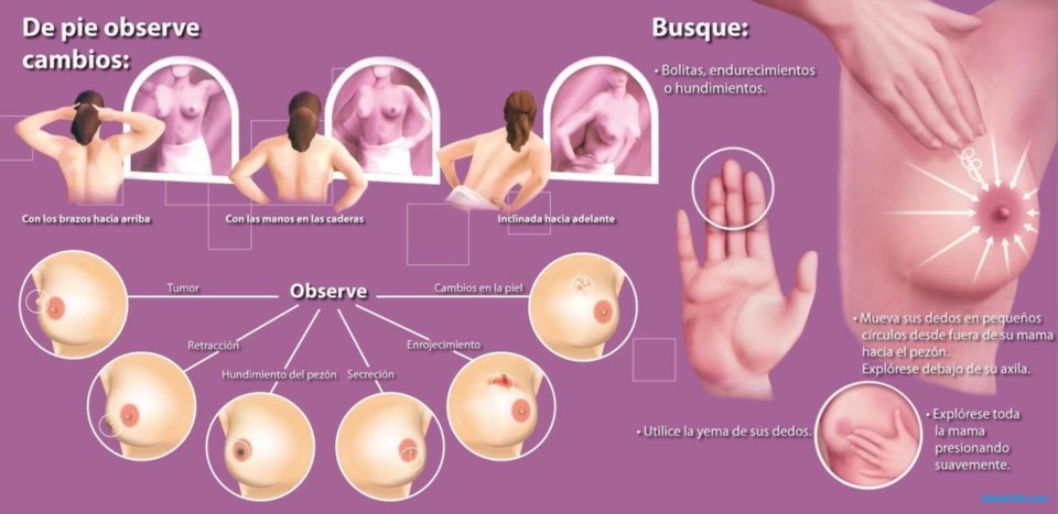 Como se hace un autoexamen de mamas