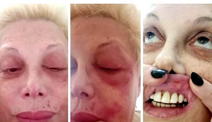 Impresionante: Carmen Barbieri tiene culebrilla y publicó ...