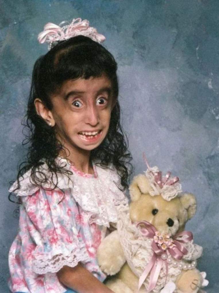 Cuando Lizzie Velásquez entró a preescolar no era consciente de su condición. Fue hasta ese momento que lo supo porque los niños no querían hablarle. LA PRENSA /GOOGLE