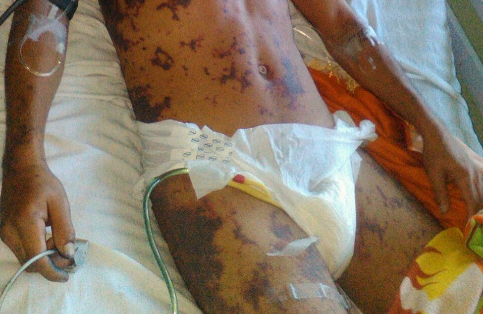Juan Rafael Lanzas, quien perdió las piernas mientras permaneció detenido en celdas de la delegación policial de Matagalpa. LA PRENSA/ CORTESÍA CENIDH