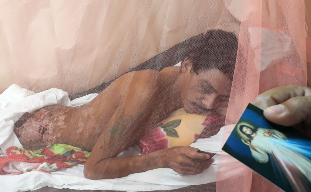 Juan Lanzas curándose de sus heridas en una cama del Hospital de Matagalpa. LA PRENSA / Óscar Navarrete.