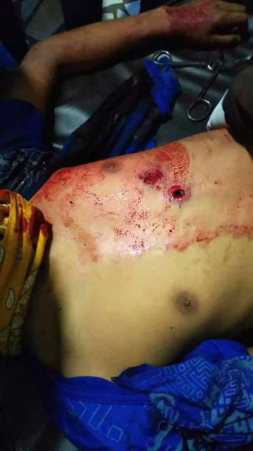 Fotografía del disparo en el tórax de Junior Gaitán. LA PRENSA / Cortesía
