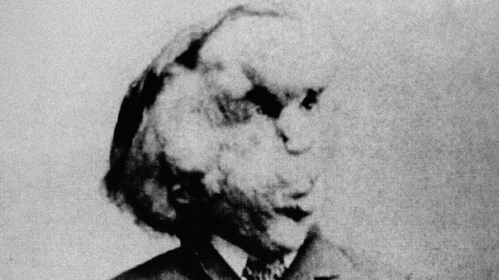 Joseph Merrick sorprendió a los médicos que lo atendieron en Londres por su inteligencia y sensibilidad. PA
