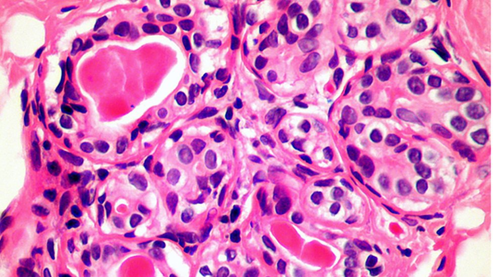 conexión al cáncer de mama de próstata