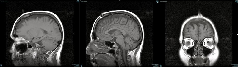 MRI images of consciousness leaving and Dharma entering the crown of Zhaxi Zhuoma. Source: Xuanfa Institute.