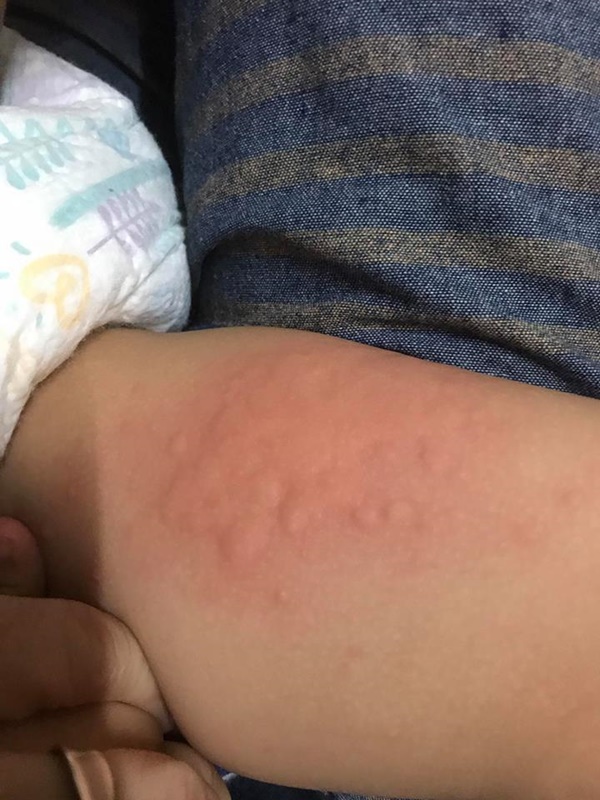 蕁麻疹是什麼 蕁麻疹怎麼止癢 有什麼飲食禁忌一次告訴你 媽咪拜mamibuy