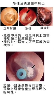 中耳炎症狀照片