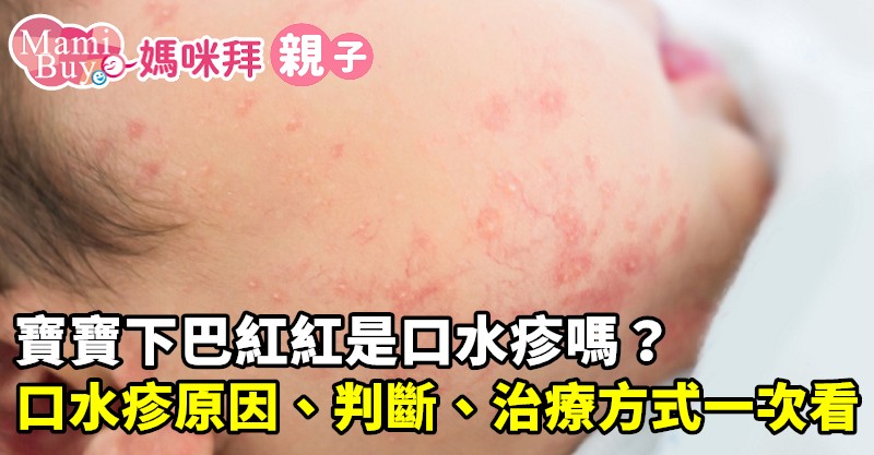 口水疹