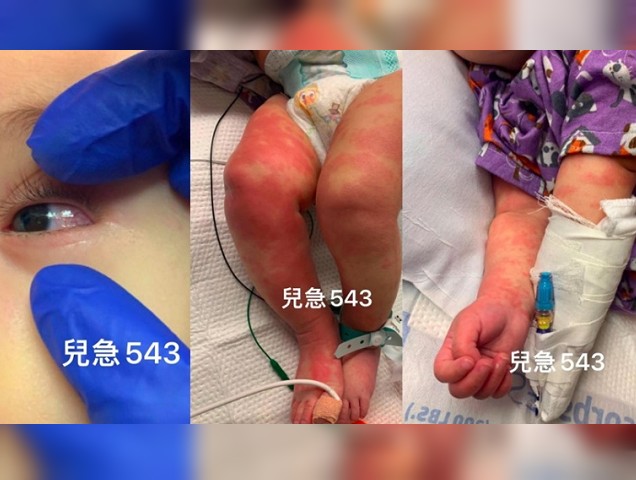 嬰兒確診紅疹
