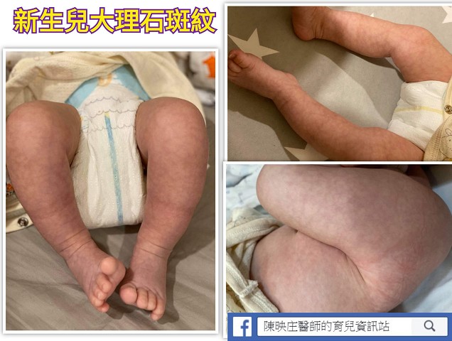 新生兒確診怎麼辦